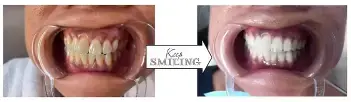 Före och efter tandblekning, resultat från Mika Marin Sthlm, Sundbyberg