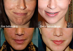 Kemisk peeling Mika Marin Sthlm: Salipeel Mediderma