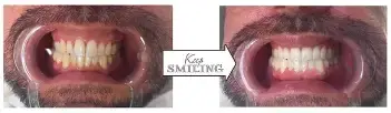 Före och efter tandblekning, resultat från Mika Marin Sthlm, Sundbyberg