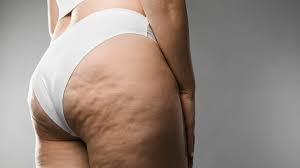 Lymfdränage Cellulitbehandling