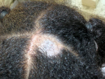 A Yeast Infection In The Scalp?😮
