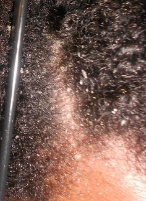 What Causes Dry Scalp?