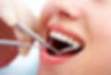 Oral Prophylaxis