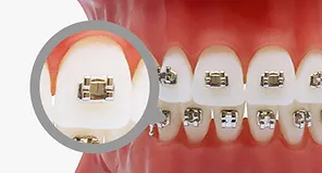 Metal Brace