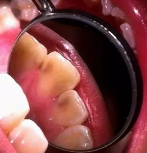 Decay of teech