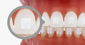 Ceramic Brace