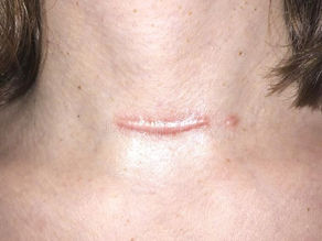 肥厚性疤痕與蟹足腫差別在哪?