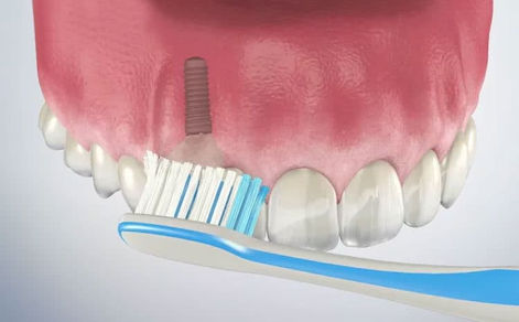 How To Take Care Of Your Dental Implants