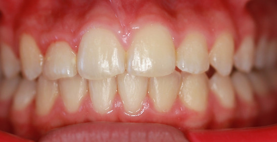 Orthodontic case 1 AFTER.JPG