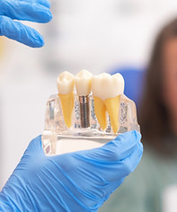 close-up-of-dental-model-with-implant-patient-of-2024-11-27-17-58-45-utc.jpg