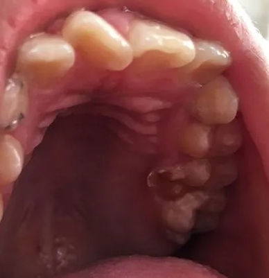 imgi_156_2.molar-retenido-palatino.jpg
