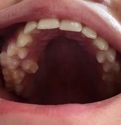 imgi_122_3.premolar-permanente-palatino-temporal.jpg