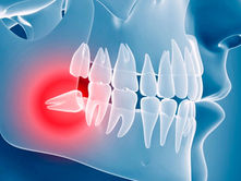 Tercer Molar o Muela del Juicio: Entendiendo la Molestia y sus Soluciones