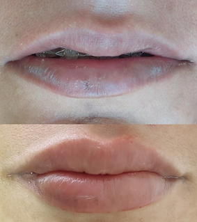 relleno de labios 2.png