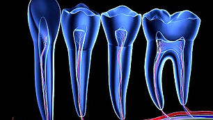 root-canal.jpg