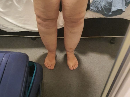 Lipoedema - My story by Katherine Goodman - Part 1