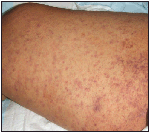 anaplasmosis.gif