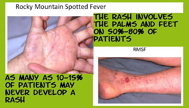 Mono Vs Rmsf Rash RMSF