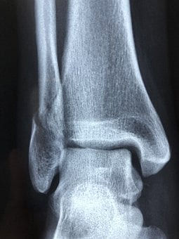 ankle pain imaging x-ray radiograph physical therapy