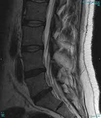lumbar mri imaging herniated disc pinched nerve sciatica