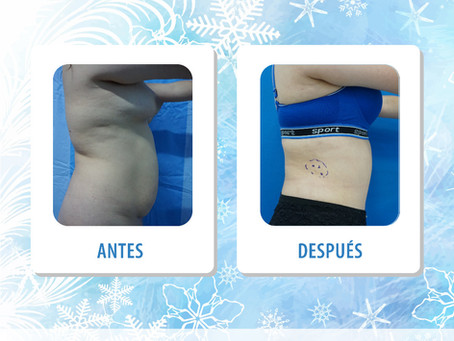 Lipo-abdominoplastia + IGG