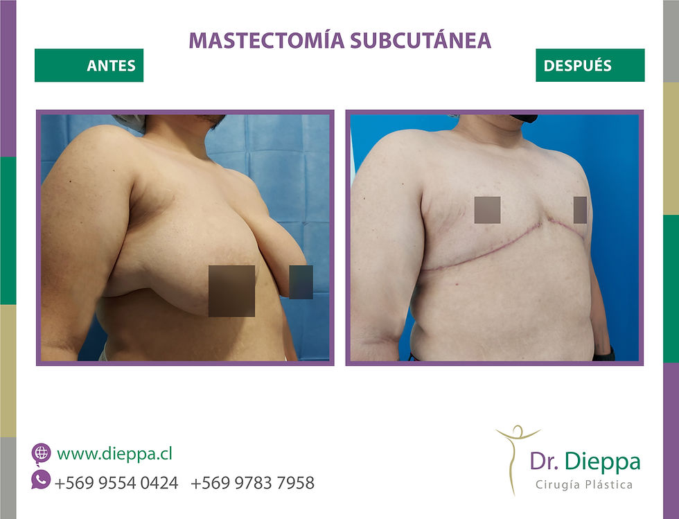 Mastectomía subcutánea 