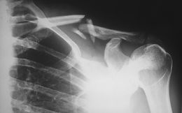 What is Injury Prevention Really About?
