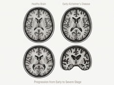 MRI brain scans illustrating Alzheimer's progression from healthy brain to severe disease, showing structural atrophy and ventricular expansion across disease stages.
