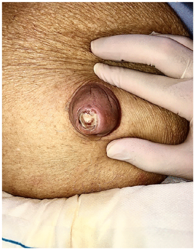 hernia.gif