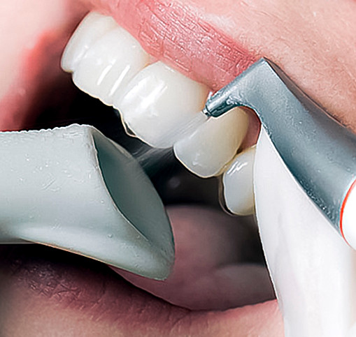 mayra leon odontologa puebla limpieza dentl airflow