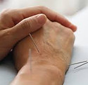 hand acupuncture.jpg