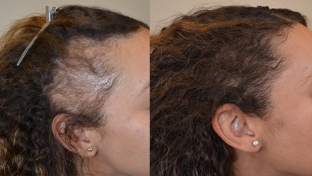 Traction-Alopecia-BA-1200x676_1024x1024.webp