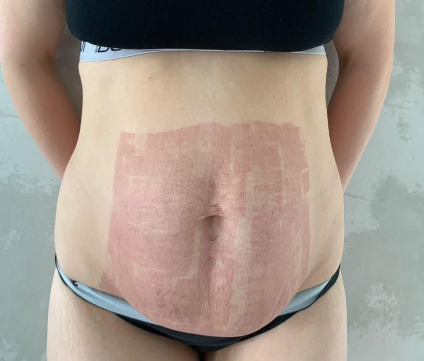Stretch Mark Reduction