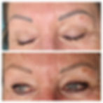 Removal of old unwanted saturated brow tattoo using Q-Switch Nd:YAG laser. healed after 2 treatments