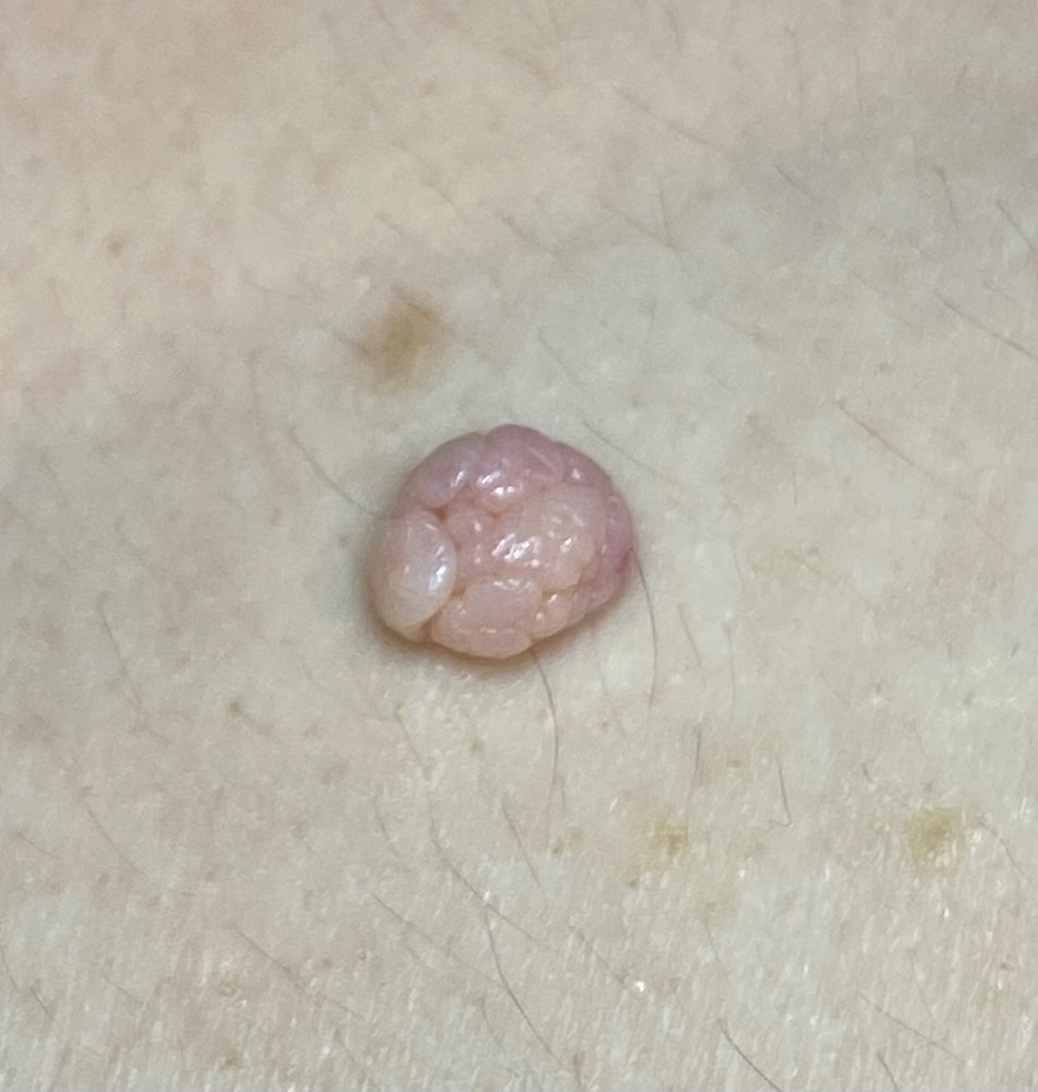 Skin Tag Like Rash Understanding Skin Tags: Causes and Remedies for Irritated Areas