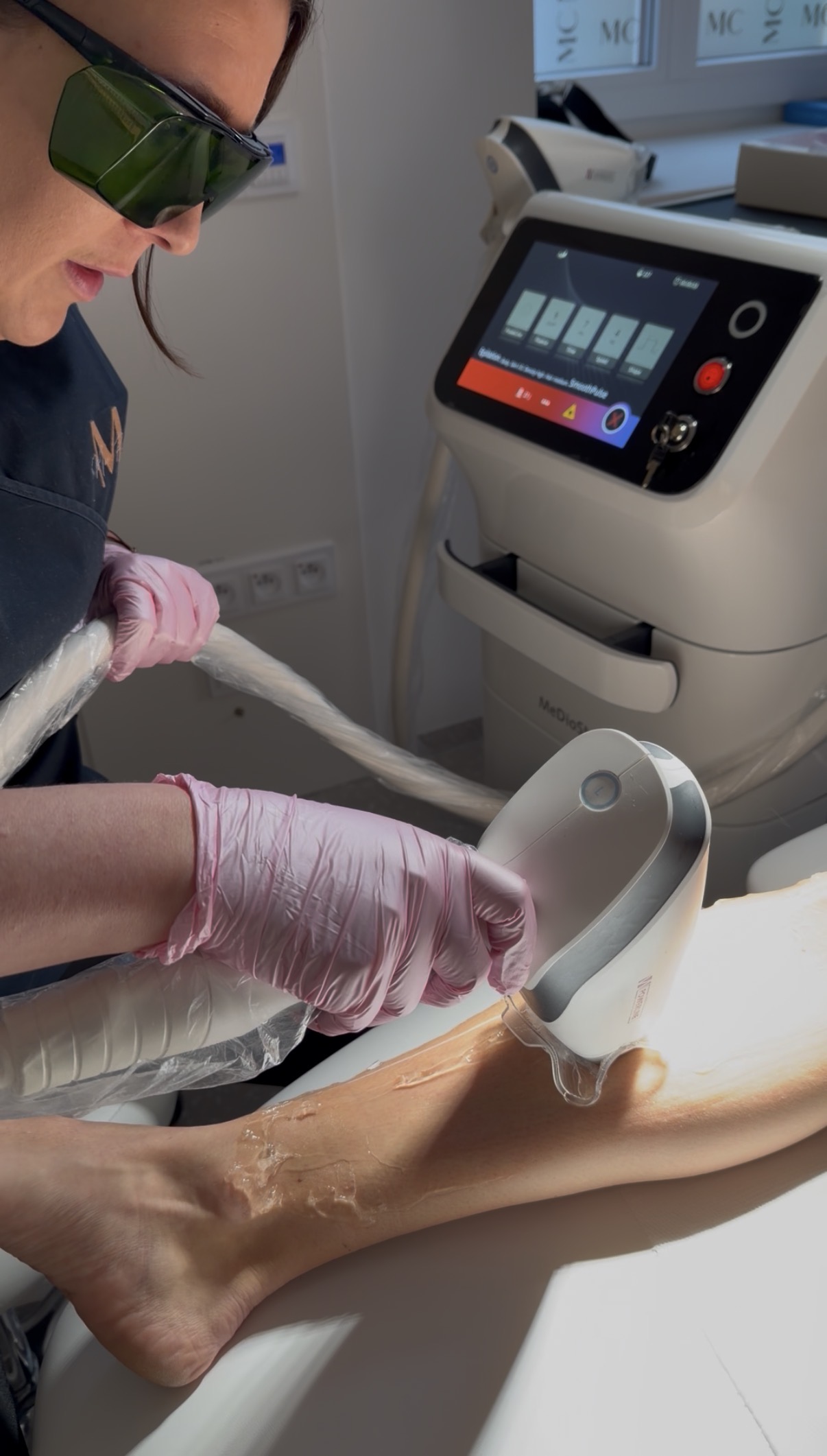 Asclepion MeDioStar diode laser for hair removal