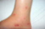 Inflamed bed bug bites on foot and ankle