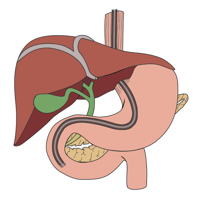 ERCP.webp