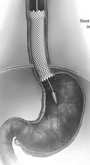 stenting 3.jpg