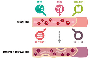 わかりやすい動脈硬化の成因 血管壁代謝を中心に  /メディカルトリビュ-ン/養老孟司（単行本） 研究室の取り組みー基礎ー