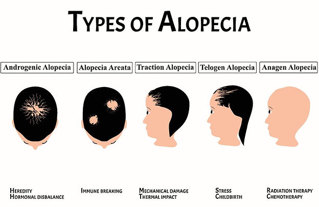 typesalopecia.JPG