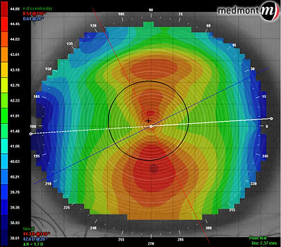 Corneal topography