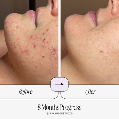 Sarah_Moon_Facial_Studio_Acne_Treatment_Facial_Results_Face_Reality_Acne_Specialist_Cystic_Nodular_Comedones_Breakouts_West_Ashley_Charleston_SC