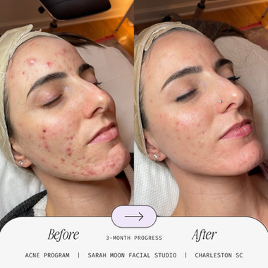 Sarah_Moon_Facial_Studio_Acne_Treatment_Facial_Results_Face_Reality_Acne_Specialist_Cystic_Nodular_Comedones_Breakouts_West_Ashley_Charleston_SC