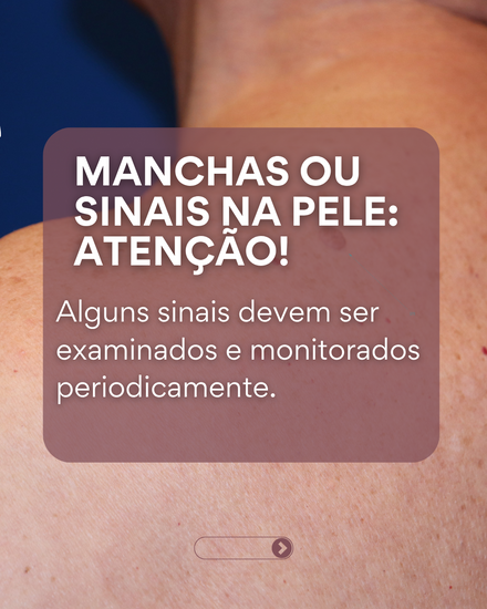 Mapeamento corporal total com dermatoscopia digital
