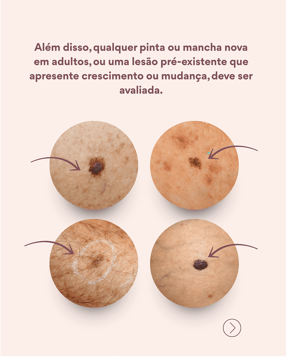 Tudo o que você precisa saber sobre o melanoma