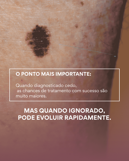Melanomas diagnosticados em Março