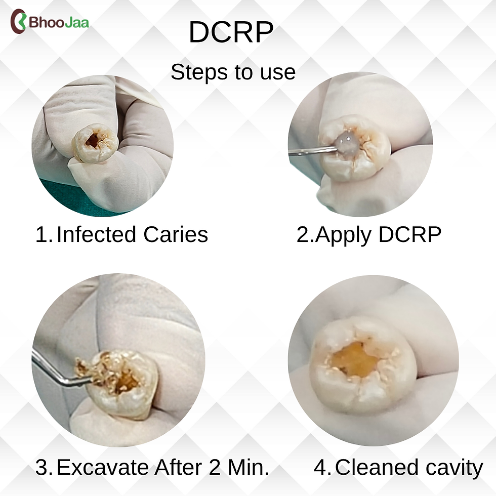 Thumbnail: DCRP- Enzyme Based Caries Removal Paste