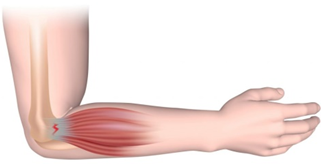 Tennis elbow