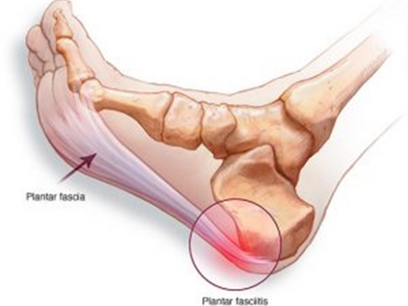 Plantar Fasciitis